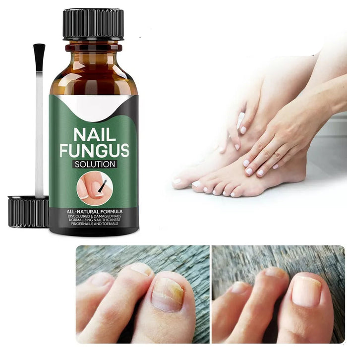 TruNail Naturals- Nail Fungus Treatment
