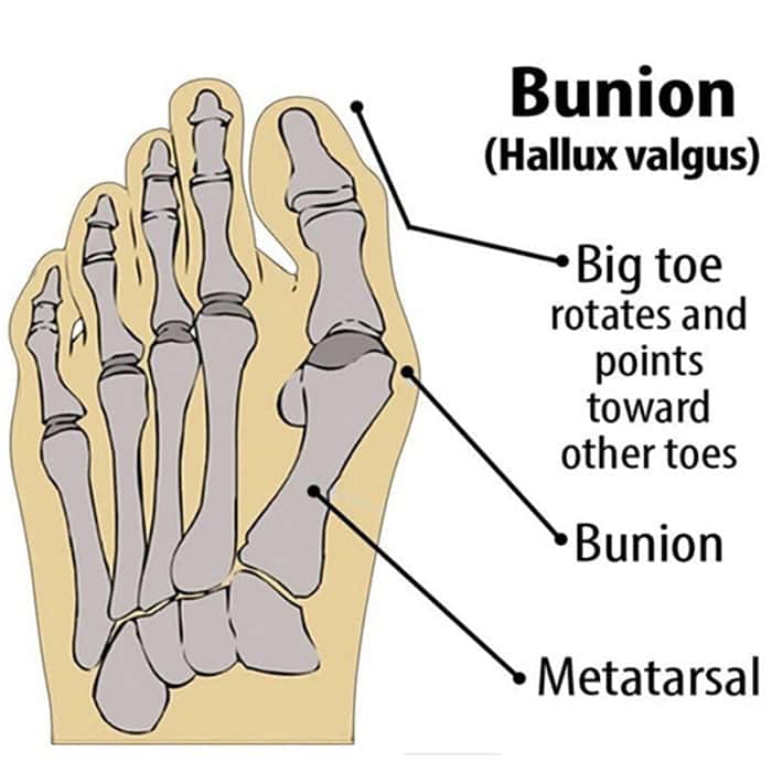HappyToe Restore - Bunion Corrector and Toe Straightener