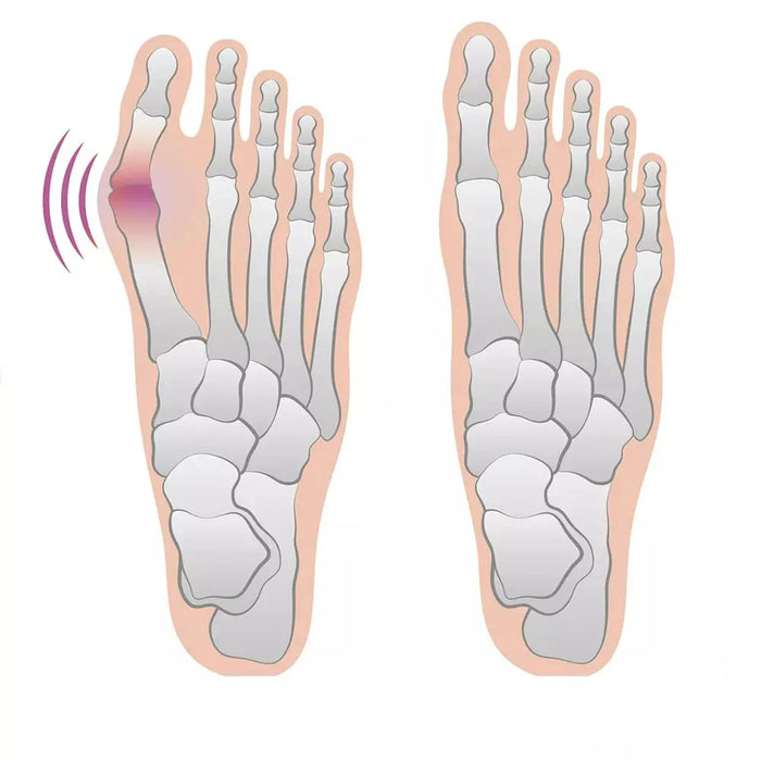 BunioCare – Bunion Pads for Pain Relief