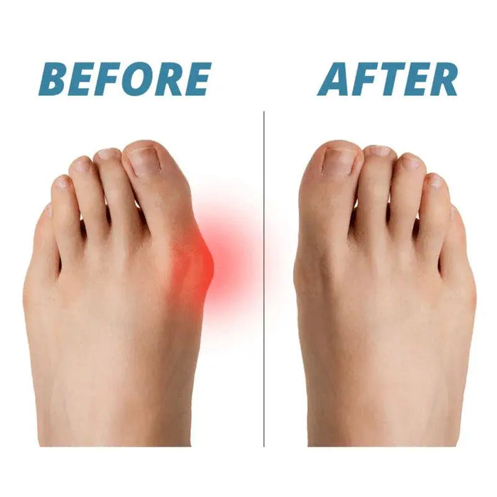 FootWell - Bunion Correction Sock