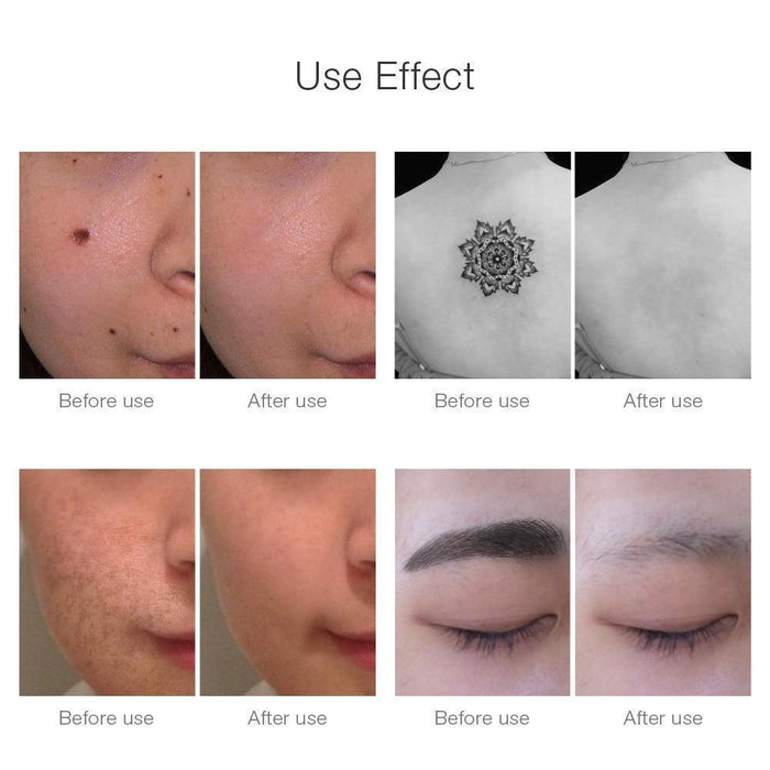 InkFade Pro - Laser Tattoo Removal Pen