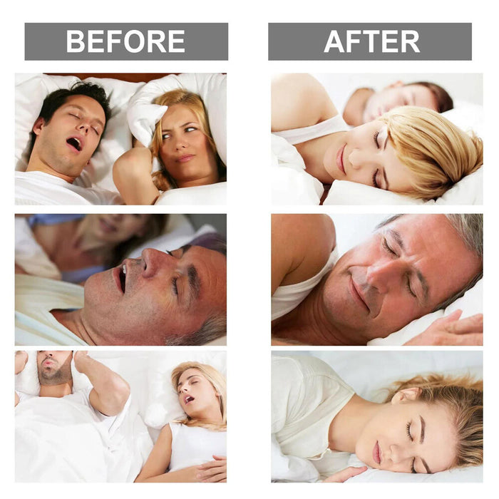SilentForm - Anti Snoring Mouthpiece