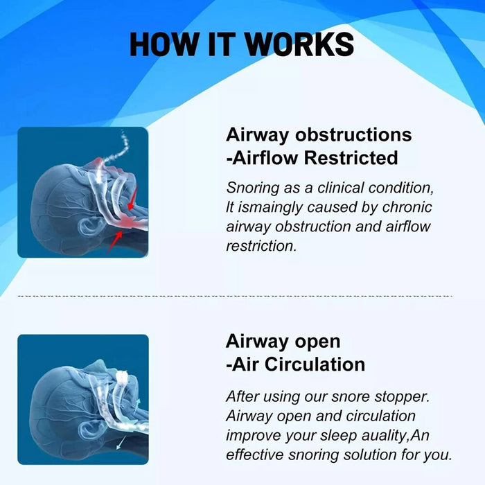 SilentForm - Anti Snoring Mouthpiece