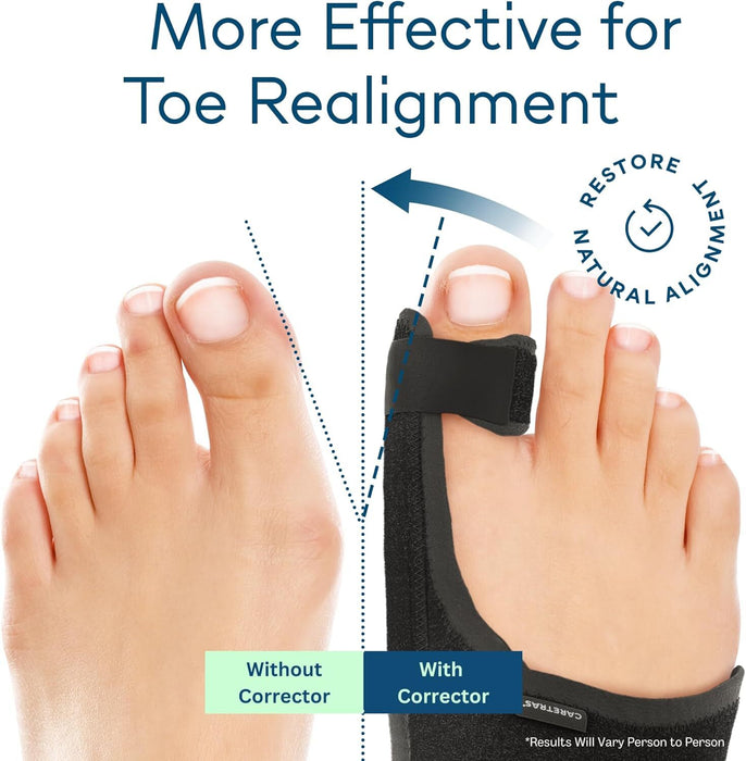 Pedi-Ease Comfort Support - Bunion Corrector for Pain Relief
