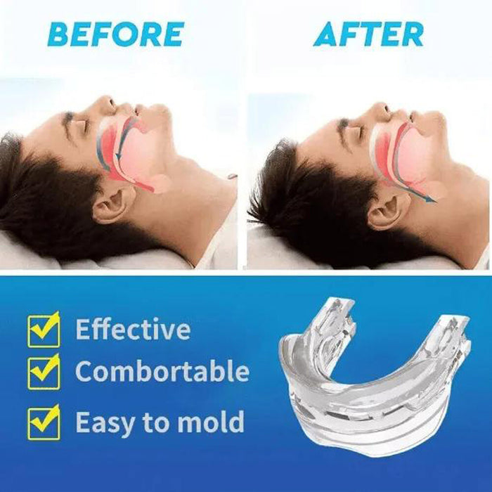 SilentForm - Anti Snoring Mouthpiece