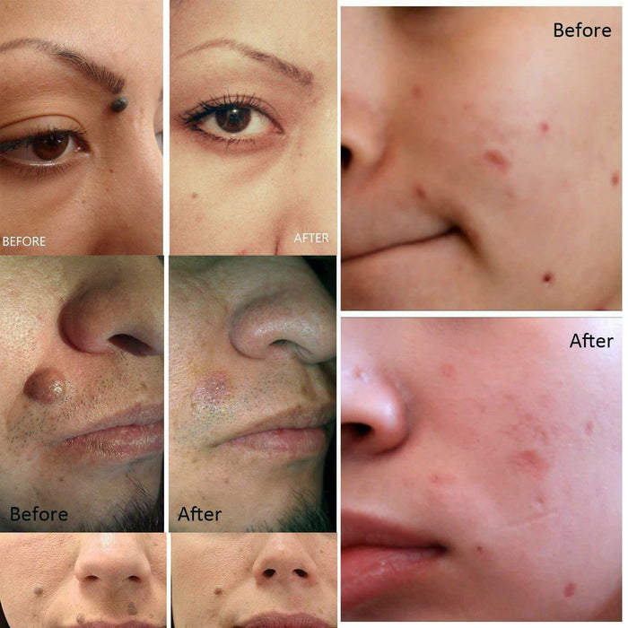SkynLift - Electric Plasma Pen for Skin Care