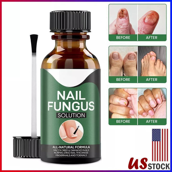 TruNail Naturals- Nail Fungus Treatment